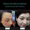 Portable Handheld Picosecond Laser Pen for Tattoo Mole Freckle Removal - 4